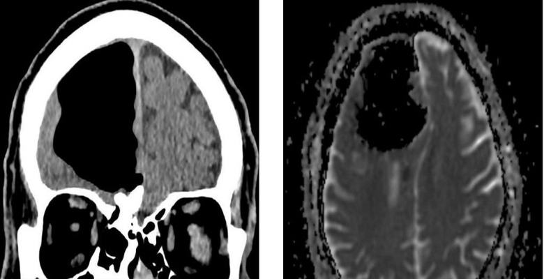 Anomalija v možganih Irca prizadela zdravnike.