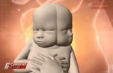 Avstralka je noseča z dvoglavim otrokom. Video.