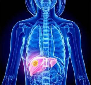 Bogati in revni trpijo za različnimi vrstami raka