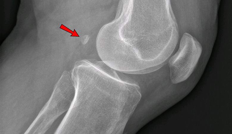 Boli vas koleno? Morda,