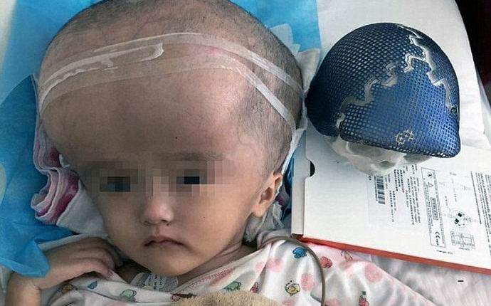 Lobanjo, natisnjeno na tiskalniku, so najprej vsadili v moškega.