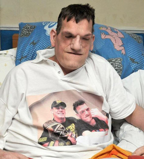 Zaradi proteusovega sindroma je moški zrasel na 240 centimetrov v višino