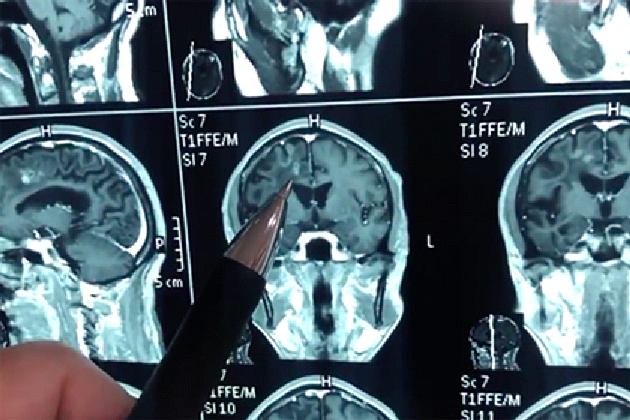 Kitajec je živel 30 let z ogromnim črvom v glavi.