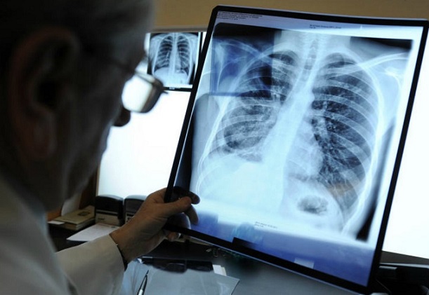 Kitajka je zaradi močnega kašlja izbila deset reber: kriv je sončni žar