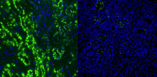 rak trebušne slinavke