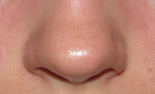 Po zdravljenju z matičnimi celicami je ameriški nos zrasel.