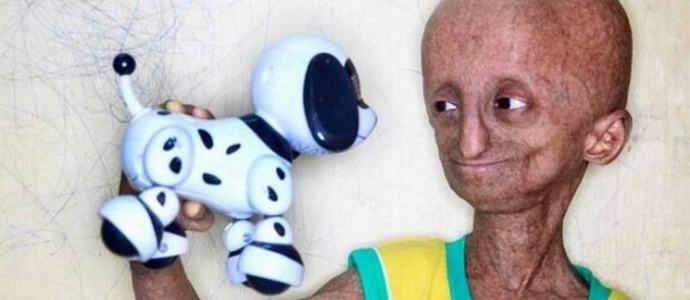 Redka bolezen je najstnika spremenila v nekakšnega tujca.