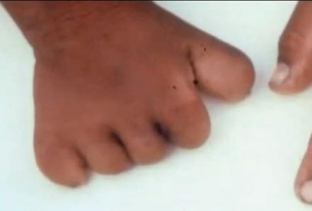 Ali so rojstni znaki povezani z nasilno smrtjo v preteklem življenju?