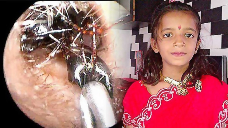 Čudni medicinski primeri z mravljami v Indiji