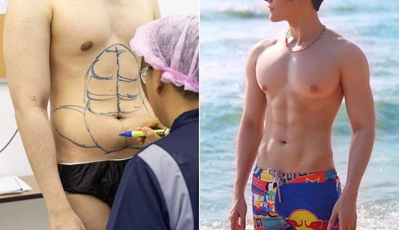 Tajska bolnišnica debelim pacientom daje videz napihnjene stiskalnice.