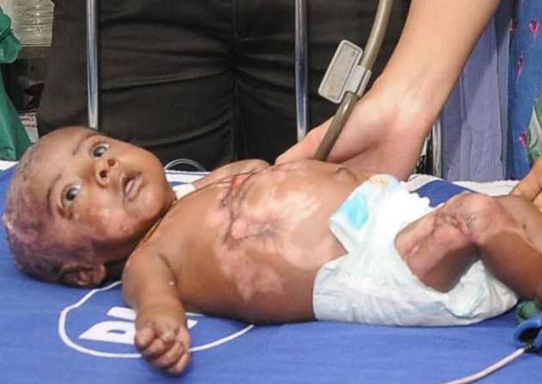 Drugi otrok trpi spontano izgorevanje pri Indijki.