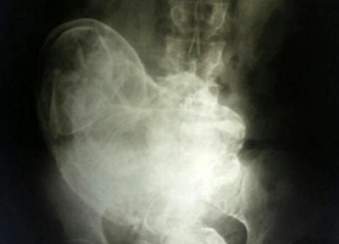 V Braziliji je 44-letna ženska v sebi nosila mrtvega otroka.