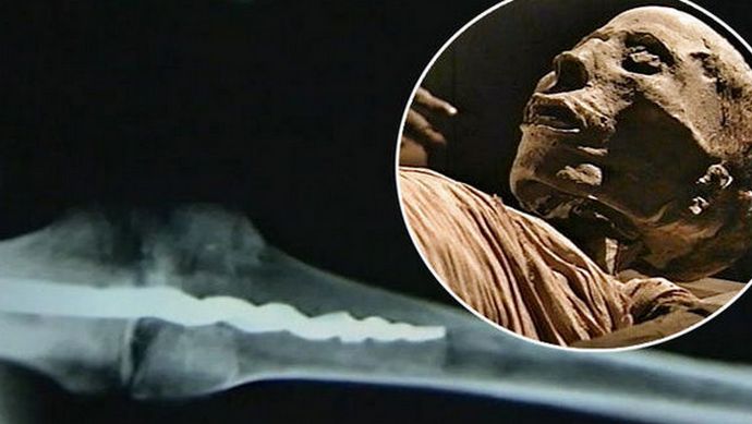 Pri mami so odkrili ortopedski zatič sodobnega dizajna.