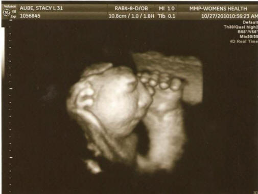 V ZDA neprimerno rastoči primeri nosečnosti z redko deformacijo ploda