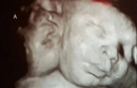 V ZDA se je rodilo dvoglavo dekle.