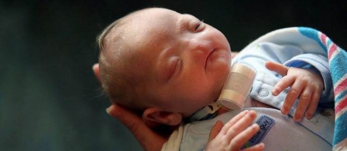 V ZDA se je rodil otrok z redko anomalijo.