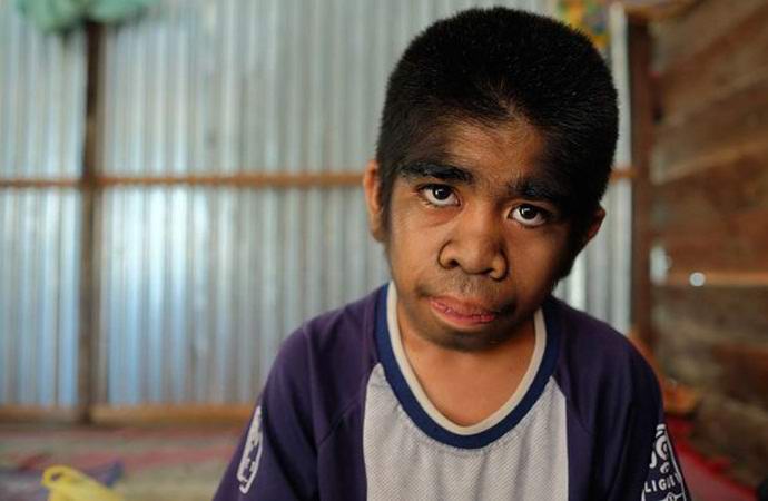 Laskav fant s sindromom volkodlaka zavrača zdravljenje