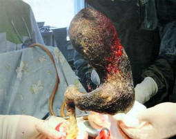 Zdravniki so iz sesalnika izvlekli štiri kilograme las