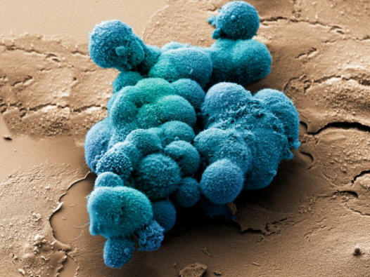 Celice raka trebušne slinavke poskušajo oblikovati volumetrično strukturo. (Foto noindexa target = _blank href = http: //www.corbisimages.comDr. Stanley Flegler / a / noindex.)