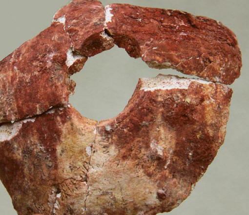 Zakaj so pred šestimi leti kirurgi naredili trepanacijo?